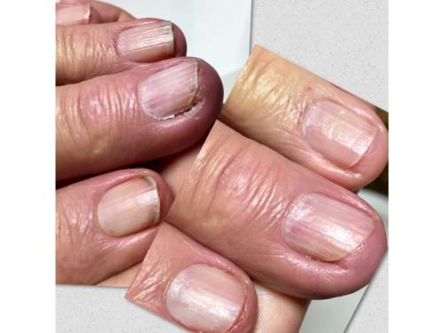 Soin de l'ongle incarné