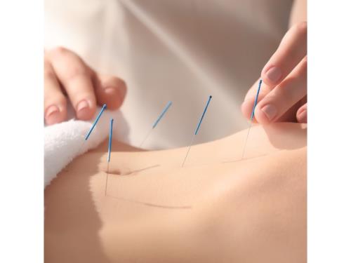 Acupuncture