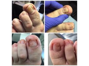 Traitement mécanique des Onychomycoses 