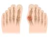 Traitement de l'hallux valgus par le pédicure podologue